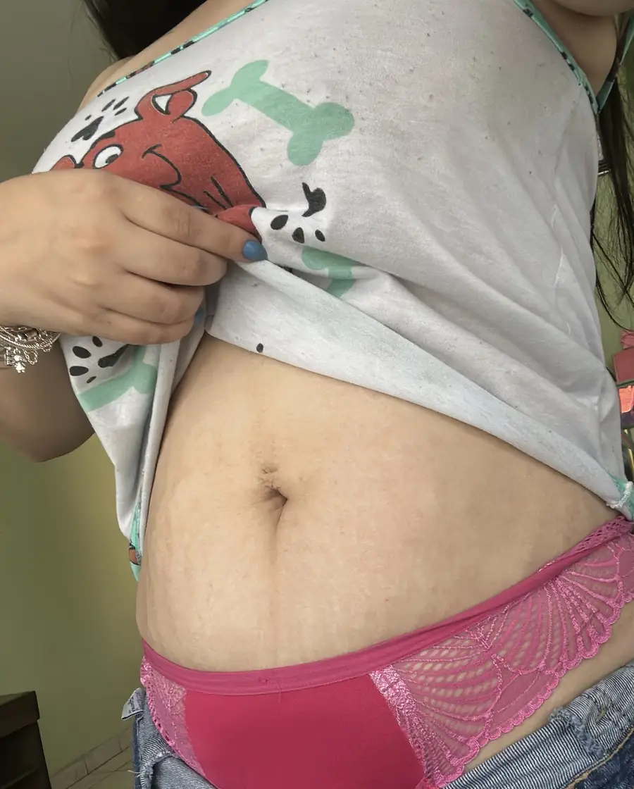 Estrias depois do Protocolo Estria Free — resultado real Bella Beauty Club Tatuapé