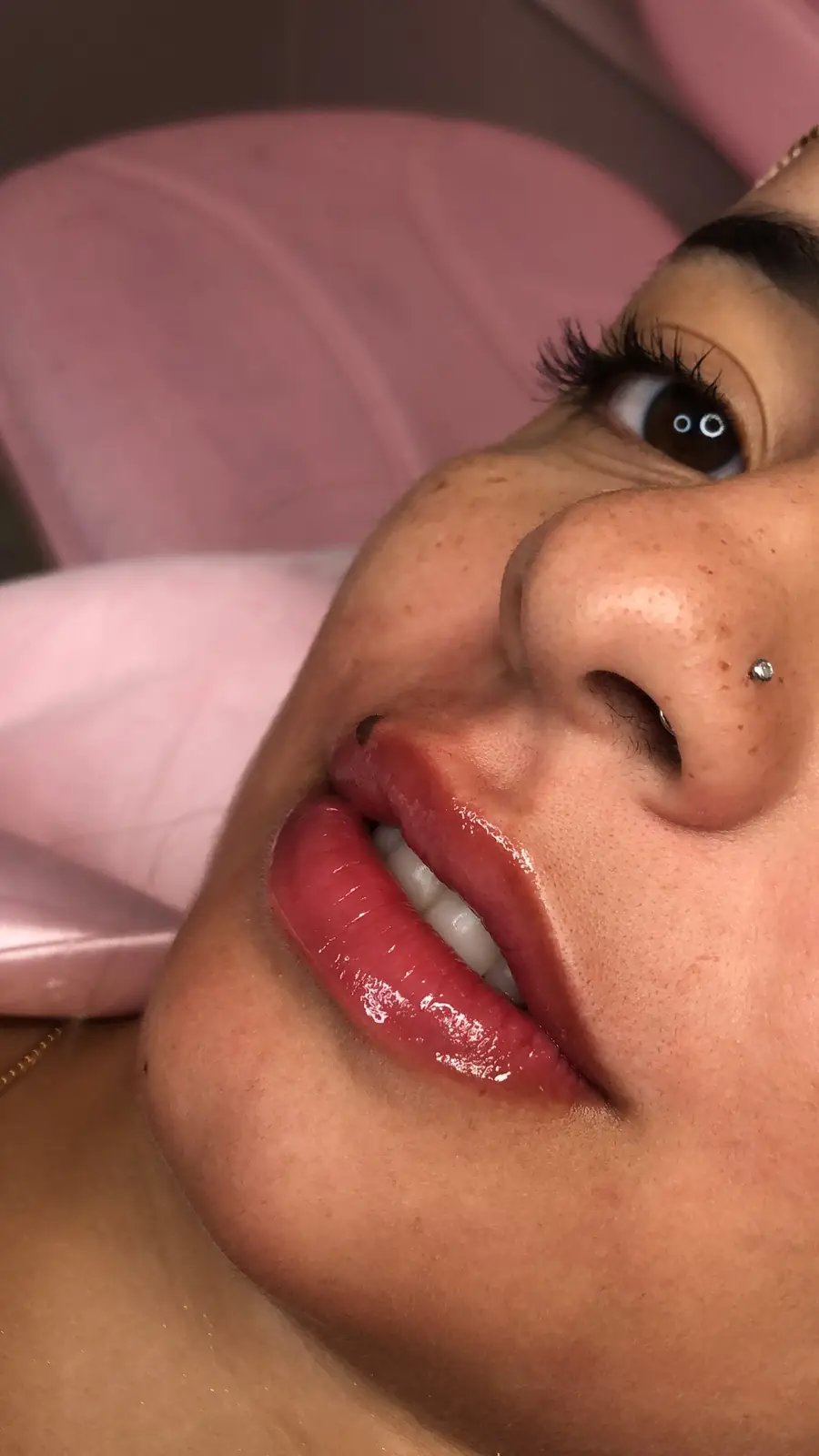 Resultado real de Hidralips — lábios volumosos e hidratados na Bella Beauty Club Tatuapé